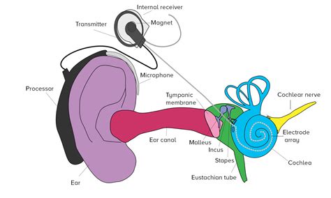 Image result for How Cochlear Implants Sound