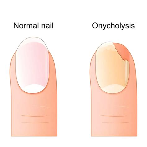 Onycholysis: Causes, Symptoms and Stages