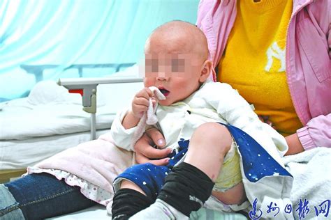 心痛！打洒面汤致十个月大婴儿全身严重烫伤，家人希望爱心人士施以援手 - 达州日报网