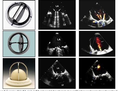 Prosthetic Valve Guidelines Echo at Mary Galvin blog