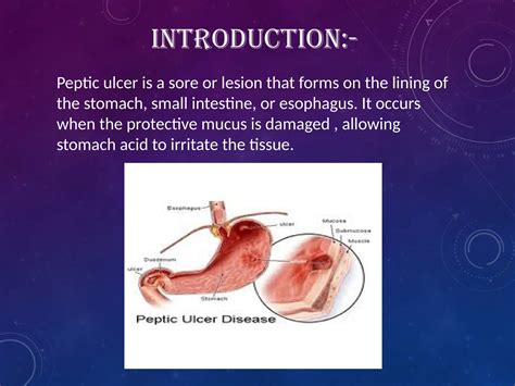 Peptic Ulcer: Types, Treatment, Drug Classification, Mechanism of Action & Side Effects | PPTX