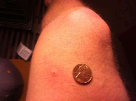 House Centipede Bite