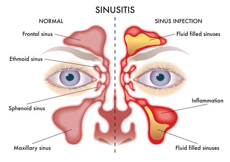Sinus Cavity Inflammation Sinus Infection (Sinusitis): 18 Signs,
