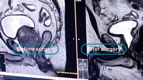 Mayo Clinic Minute: Can lifestyle changes help with enlarged prostate ...