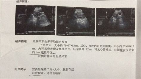 怀孕49天B超数据 d1:2.80cm d2:1.76cm d3:2.61cm GS:2.39cm GA: 7WOD 求高人看看男孩女孩 ...