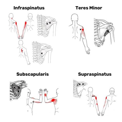 Referred Pain – The Rotator Cuff - Kamloops Physiotherapy