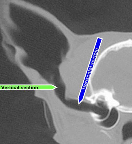 Image result for Contralateral Ear