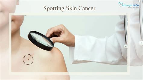 Types Skin Cancer Signs 的图像结果