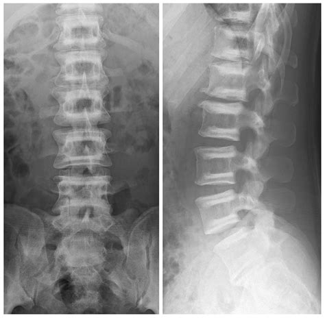 Rugger-jersey spine in osteopetrosis | BMJ Case Reports