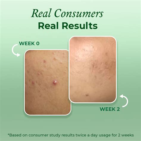 Acne Face Wash with Salicylic Acid - Buy Clearing & Calming Acne Face ...