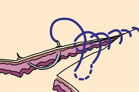 Image result for Continuous Suture Patterns