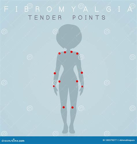 Fibromyalgia Trigger Points