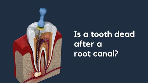 Dead tooth root canal before and after | Hummingbird Dental | Voted Top Choice Richmond Hill Dentist