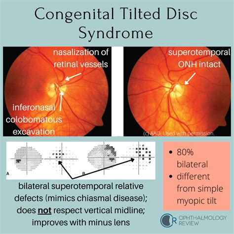 Ophthalmology Review