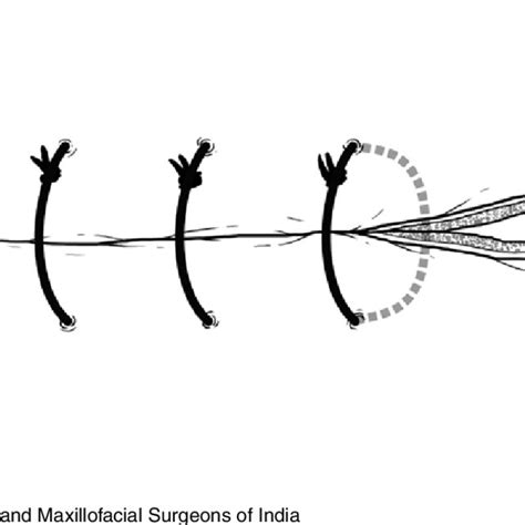 Image result for Simple Continuous Suture Removal
