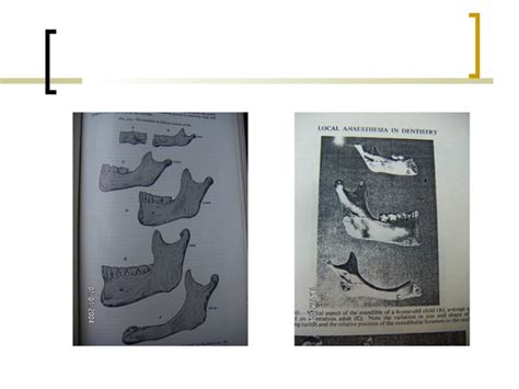 Local Anesthesia 的图像结果