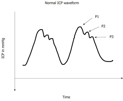 Intracranial pressure monitoring: Gold standard and recent innovations