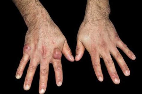 Rheumatoid Arthritis Nodules On Fingers
