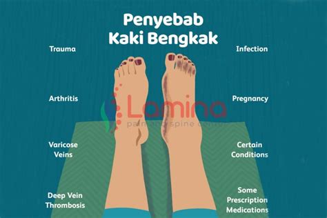 cara mengatasi kaki bengkak karena penyakit jantung