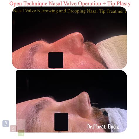 Nasal Valve Collapse and Treatment