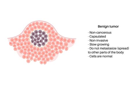 Benign Tumor Diagram