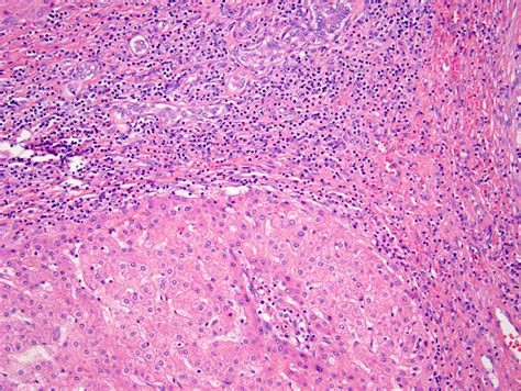 Focal Nodular Hyperplasia Liver