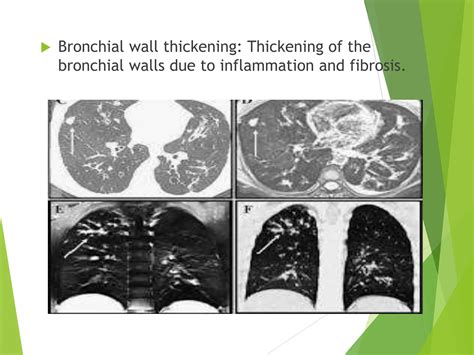 Diagnosis and Imaging of Bronchiectasis.ppt