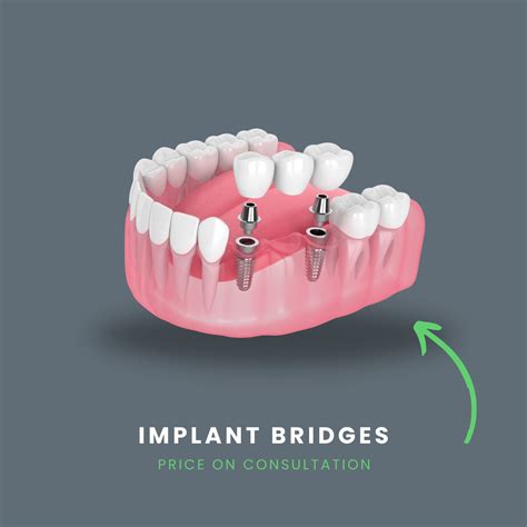Dental Bridge Cost