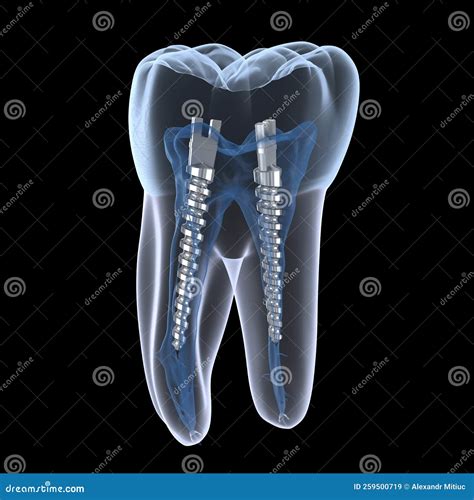 Dental Steel Post Inside Molar Teeth, Xray View. Dental Endodontic ...
