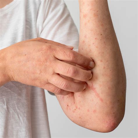 Psoriasis Safety | Mascot Spincontrol India Pvt Ltd