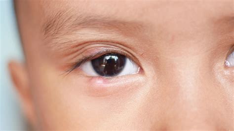 Blinking Of Lower Eyelid