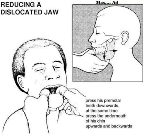 Locked Jaw Definition