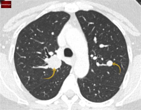 Multiple lung nodules – the Radiologist