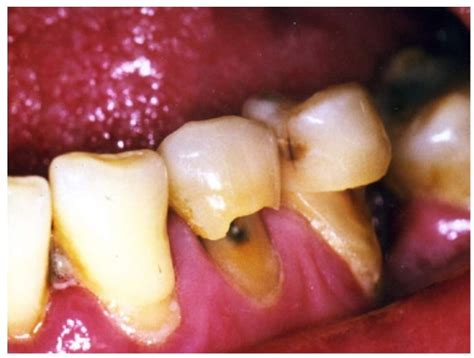 Understanding Dental Abrasion: Causes & Treatments | SmileWide