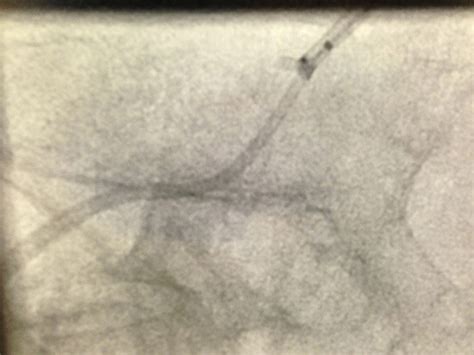 Image result for Perclose Device Tutorial