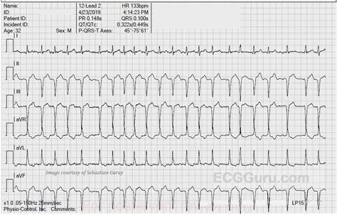 Atrial fibrillation | ECG Guru - Instructor Resources