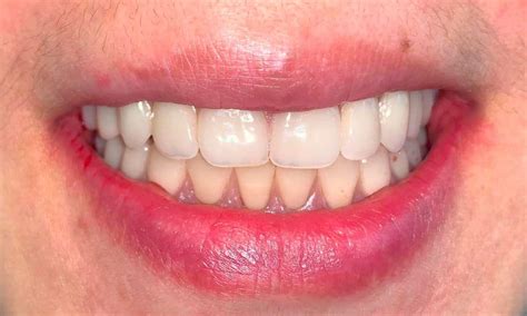 Image result for Immediate Dentures Procedure