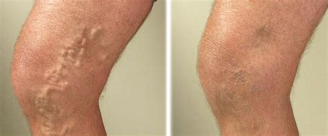 Vascular and Endovascular Surgery in adajan, Surat