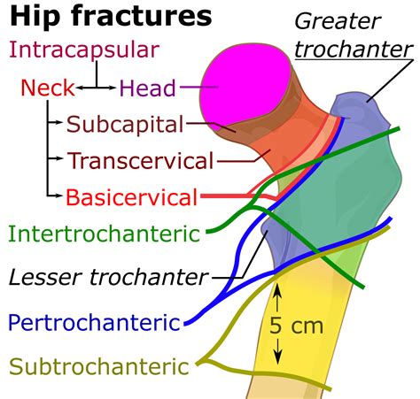 Anatomical Classification Of Femoral Neck Fractures at Laverne Haskins blog