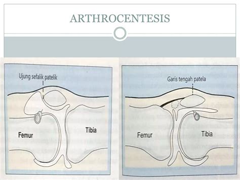 Diagnostic approach to knee joint effusion | PPTX
