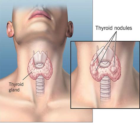 Solitary thyroid nodule causes, symptoms, diagnosis, treatment & prognosis