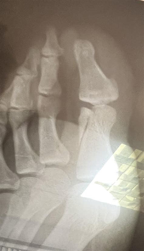 Image result for Toe Surgery