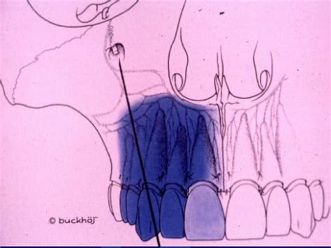 Maxillary Local Anesthesia 的图像结果