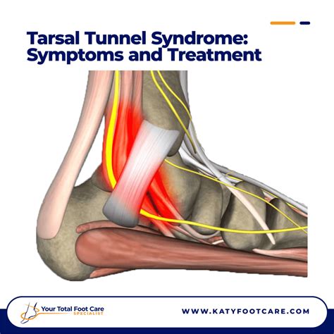 Tarsal Tunnel Syndrome Treatments