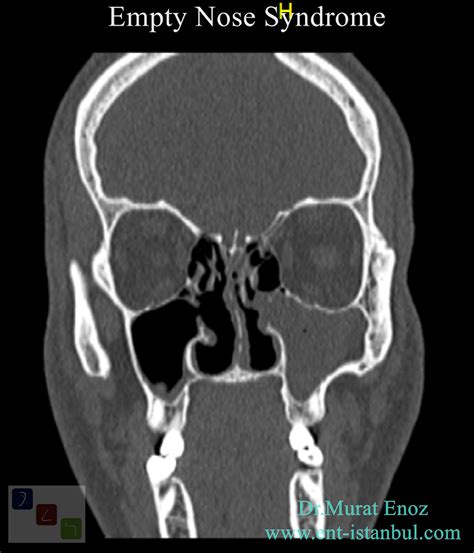 Cool, Small, Dry Turbinate: Empty Nose Syndrome