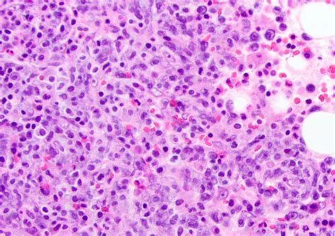 Spindle Cell Pathology Outlines at Loretta Cyr blog