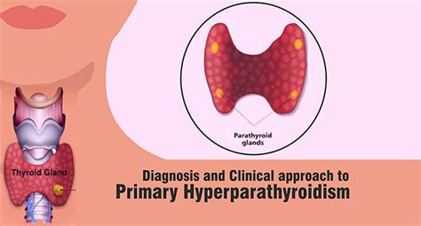 Diagnosis and Clinical Approach to Primary Hyperparathyroidism ...