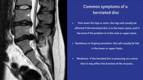 Lumbar Disc Herniation Symptoms