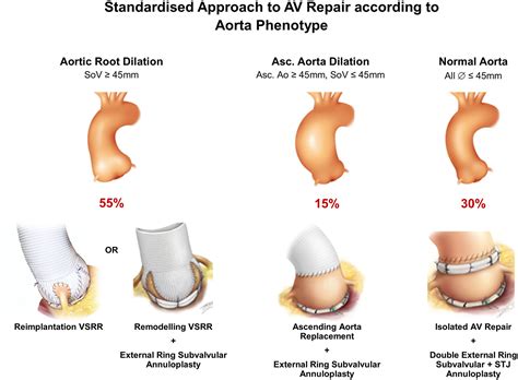 Aortic Valve Repair: State of the Art - Emmanuel Lansac, Pouya Youssefi ...