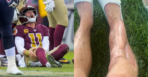 Alex Smith Shares Gruesome Photo Of His Surgically Repaired Leg Six ...
